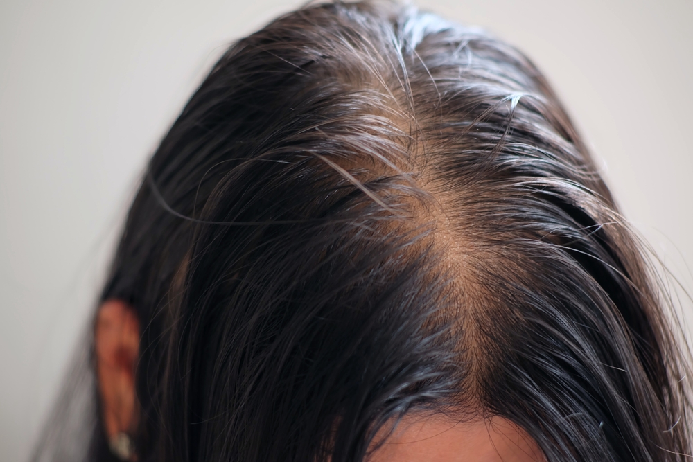 causes of hair loss