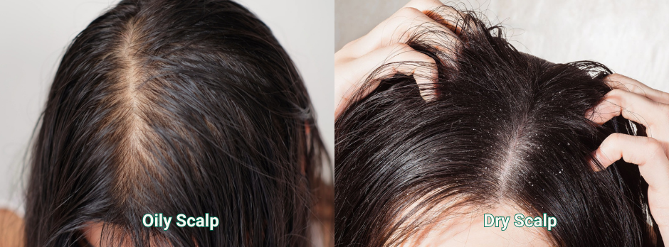 Oily scalp vs dry scalp comparison image showing key differences in scalp condition.