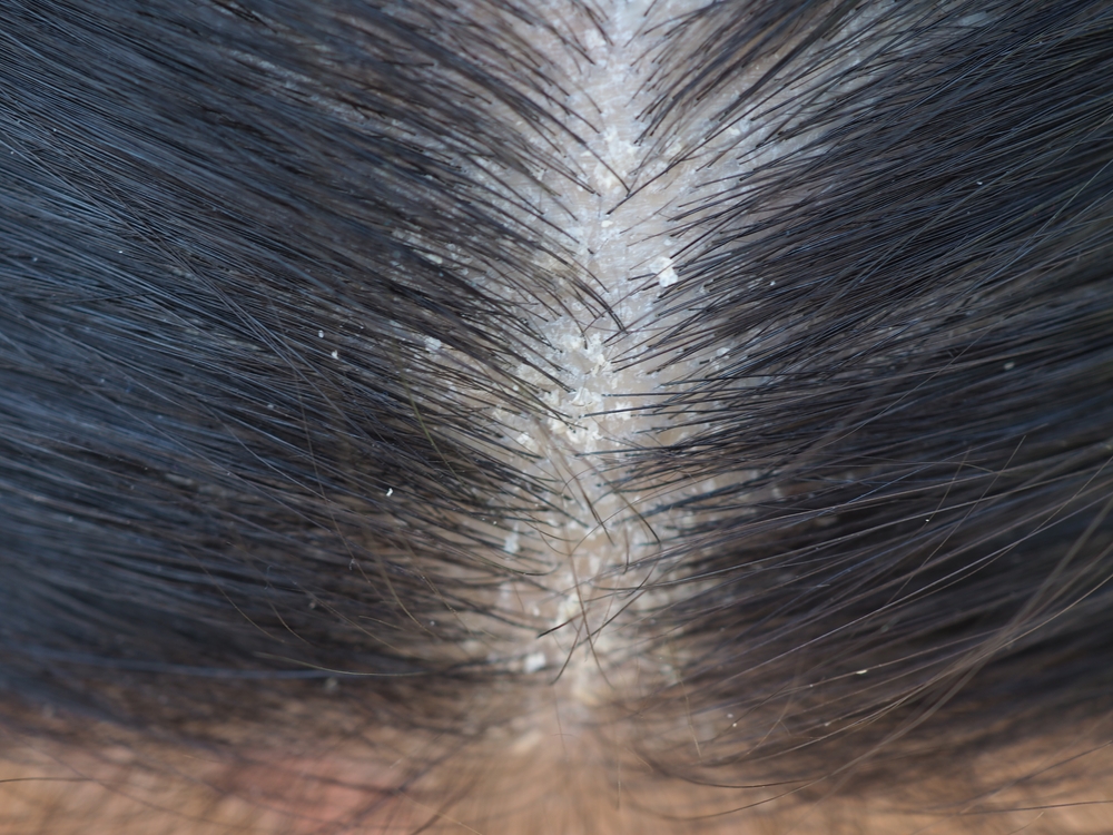 Dry scalp condition with flaky skin buildup visible between hair strands. 