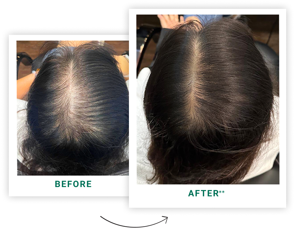 Before and After Treatment Result 2
